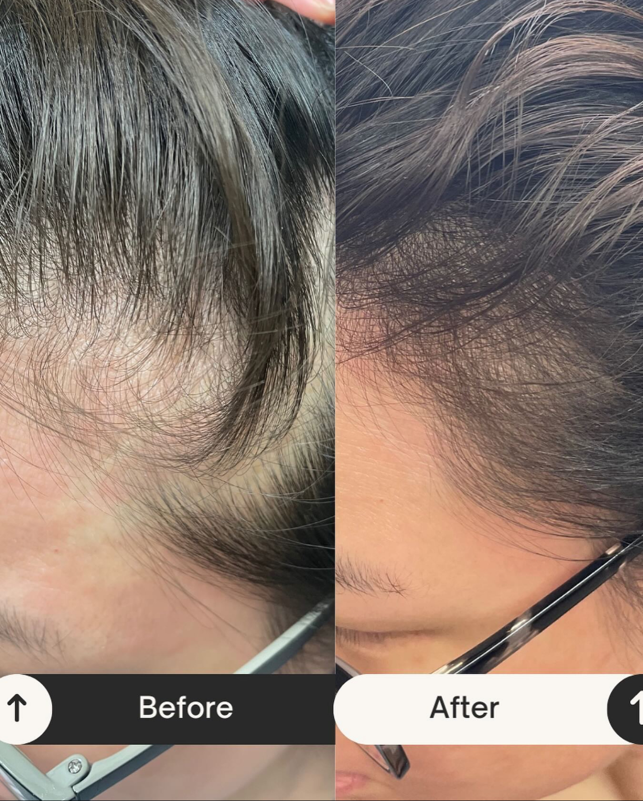 Side-by-side before and after photographs showing a client's hairline